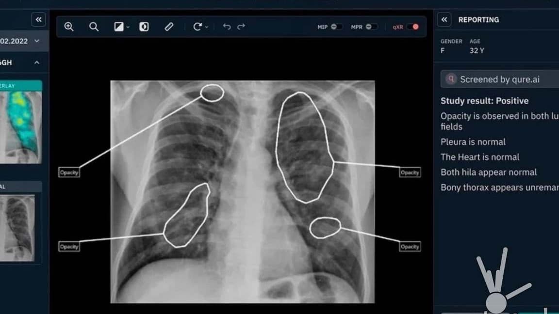 AI-assisted chest X-ray with possible lung opacity regions outlined